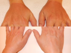 hand treatment