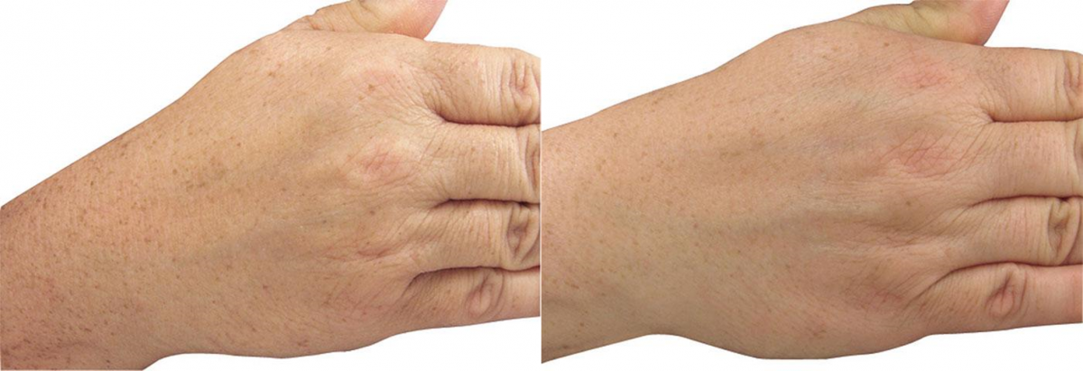 Before and after of patient's hands after anti-age spot treatment in Rochester, NY