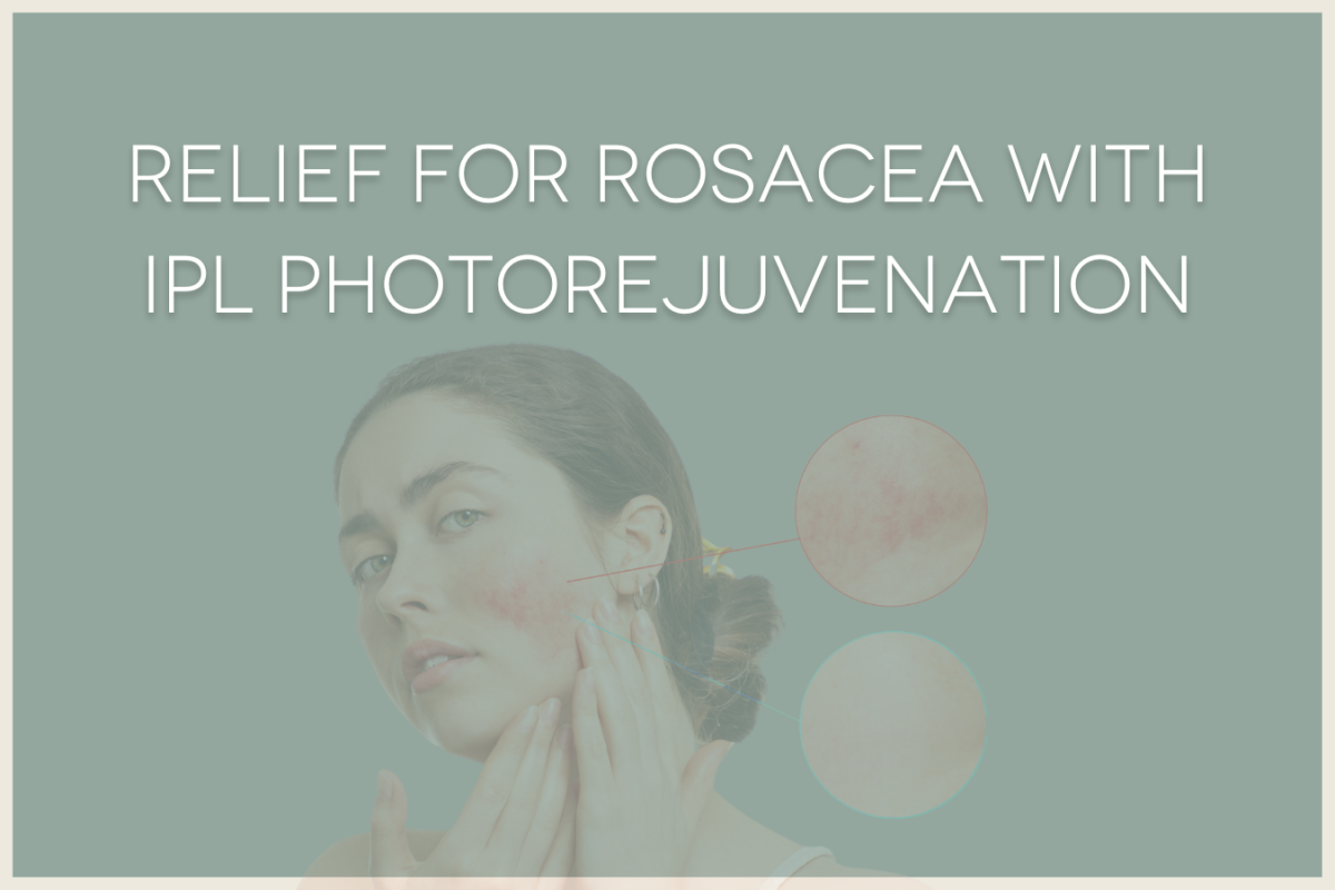 Relief for rosacea with IPL photorejuvenation, image of woman with rosacea, hands near face