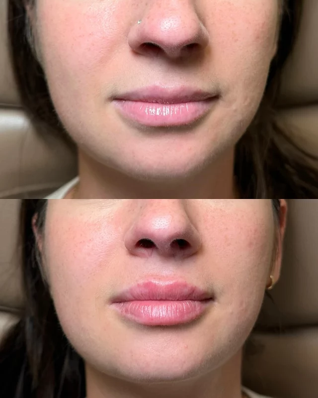 A little goes a long way.
This patient had a beautiful result from her lip flip - but wanted just a bit more structure and definition.
We used ½ syringe of Volbella to:
• Define the lip borders
• Enhance the Cupid’s bow
• Maintain a natural, balanced look
This subtle enhancement helped bring everything together - without overfilling or changing the overall shape.
Injector: Stacy