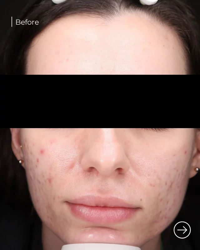 This gorgeous patient is 3 months post her 3rd Total Skin treatment with LaseMD Ultra & Potenza, performed by Jenna - and the results are incredible! 
We targeted her acne scars, and they’ve lightened up tremendously, leaving her skin smoother, brighter, and more even-toned.
What is Total Skin?
It’s a powerful combination treatment using two advanced technologies:
- LaseMD Ultra – a gentle yet effective non-ablative fractional laser that resurfaces the skin, improves tone & texture, and enhances collagen production.
- Potenza RF Microneedling – combines microneedling with radiofrequency energy to stimulate deep collagen remodeling, tighten skin, and treat scars at a deeper level.
Together, they treat both the surface and deeper layers of the skin for comprehensive, long-lasting results.
Ready to see what Total Skin can do for you? Book a consult today!