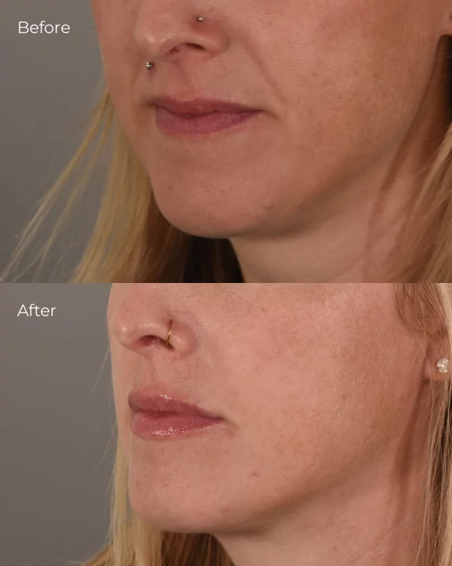 First time filler! 

Andrea corrected this patients M-shaped lips with 1 syringe💉