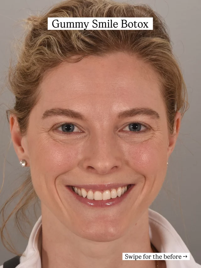 If you notice your gums show a lot when you smile, this treatment can be a game-changer 

Lip flip (6 units) + gummy smile correction (6 units)

Injector: Andrea

Interested in this treatment? Tap the link in our bio to book your consultation🙌