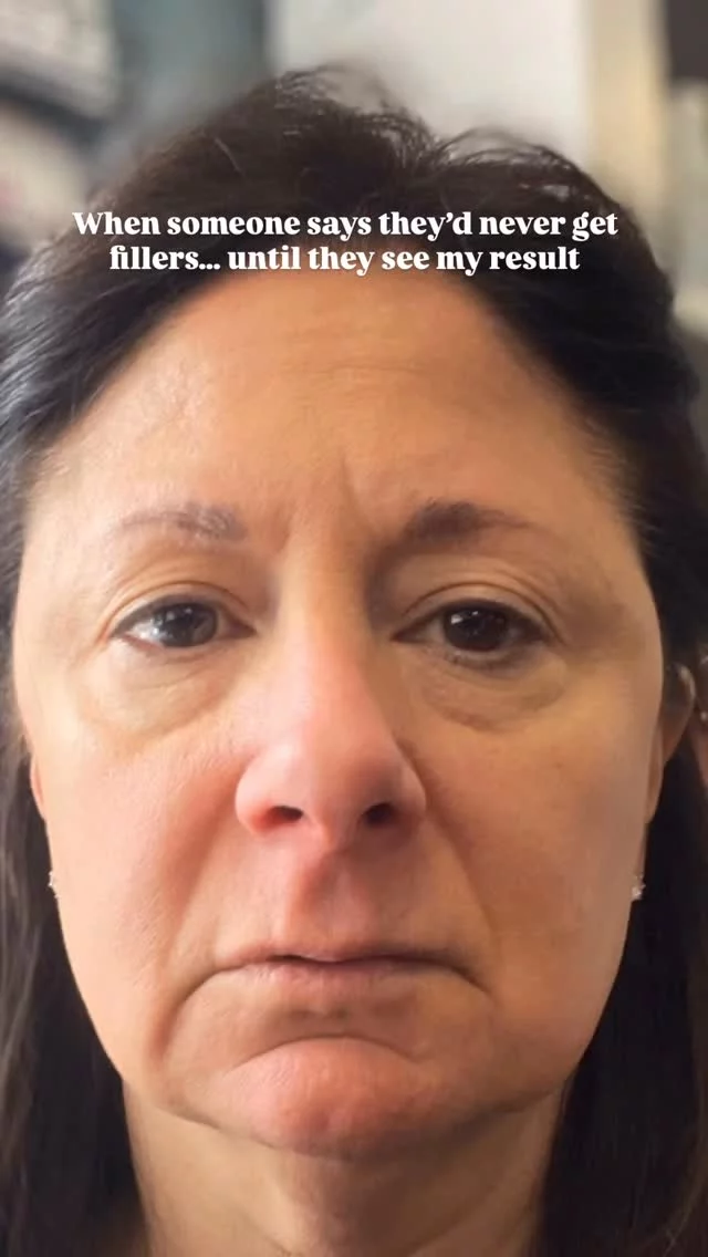 This transformation was a part of an injector training with our owner and double board-certified facial plastic surgeon, Dr. Quatela. Our team focused on:

✔️restoring volume in the mid-face
✔️defining the jawline for a sculpted appearance
✔️reducing hollowness in the under eyes
✔️ softening lines and wrinkles 
✔️enhancing lips with a lip flip

Not every patient needs full face rejuvenation, but this is what happens when you look at the face as a whole rather than spot treating.

Interested in this treatment? Tap the link in our bio to book your consultation🙌