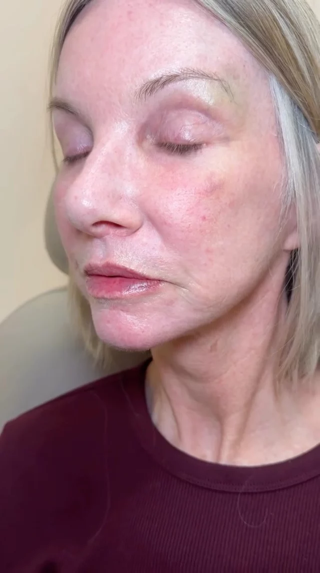 Cold weather = dry lips ❄️ 

One syringe of Volbella brought her lips back to life, smoothing vertical lines and giving her that youthful, hydrated look she’s been missing 💕 She loved her results! 

Injector: Andrea

Ready for winter-proof lips? Comment LIPS below to schedule your appointment.