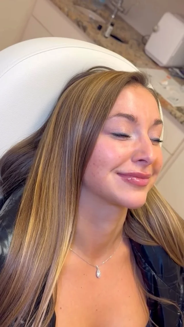 Sometimes all it takes is a little refresh 💉 

This patient had a subtle lip filler touch-up by Stacy for soft, plump lips she’s loving!

Comment “LIPS” to schedule your appointment today🤍