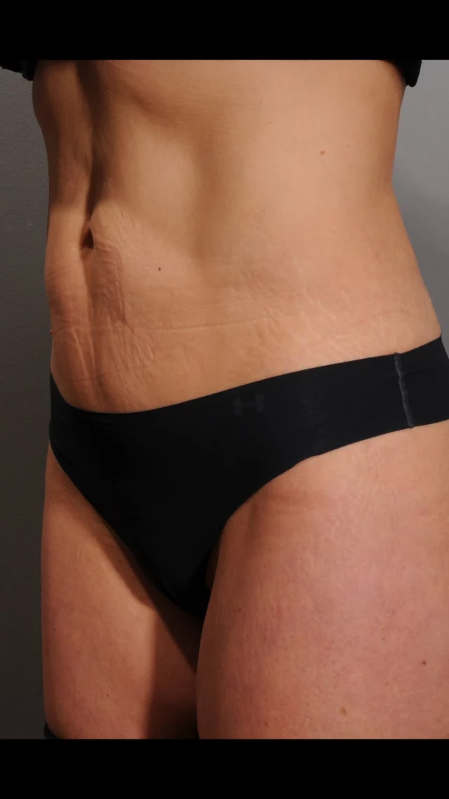 If you’re ready for stronger, more defined muscle without surgery or downtime — now’s the time.

🔥 Buy 3 EmsculptNEO treatments, get 1 FREE

Comment “SCULPT” to grab this deal before February 28. 

Treatments must be completed by June 30. Restrictions apply.