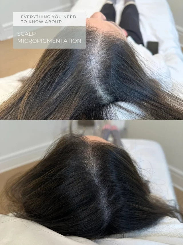 Dealing with hair loss? You’re not alone.

Whether you’re a woman noticing wider parts and thinning density, or a guy watching your hairline creep back—scalp micropigmentation can help. It’s tiny dots of pigment placed in your scalp that look like real hair follicles.

The result? Fuller-looking hair that actually looks natural.

This transformation was done by Geena — and these photos show results after just ONE treatment.

• Typically 2–3 sessions total 
• Minimal downtime
• Results last several years

DM “SMP” if you want to learn more about this treatment.